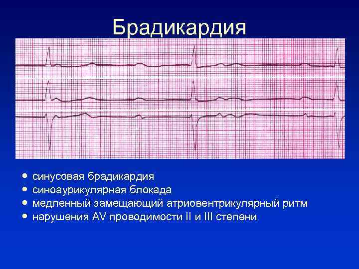 Брадикардия синусовая брадикардия синоаурикулярная блокада медленный замещающий атриовентрикулярный ритм нарушения AV проводимости III степени