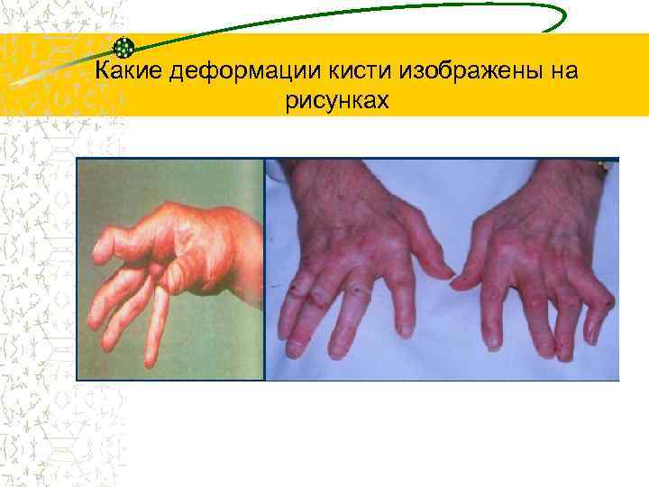 Какие деформации кисти изображены на рисунках 