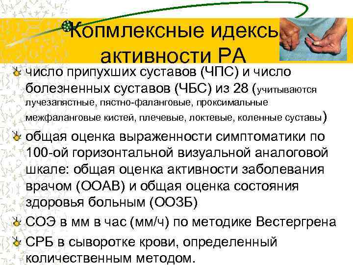  Копмлексные идексы активности РА число припухших суставов (ЧПС) и число болезненных суставов (ЧБС)