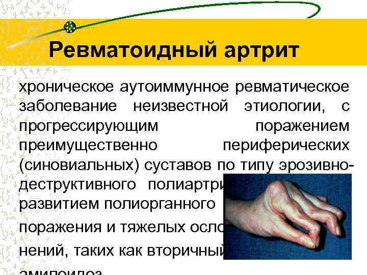 Ревматоидный артрит хроническое аутоиммунное ревматическое заболевание неизвестной этиологии, с прогрессирующим поражением преимущественно периферических (синовиальных)