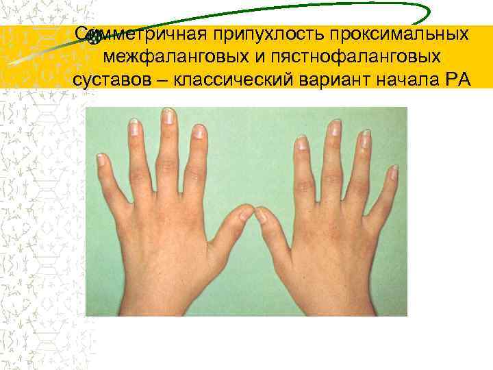 Симметричная припухлость проксимальных межфаланговых и пястнофаланговых суставов – классический вариант начала РА 