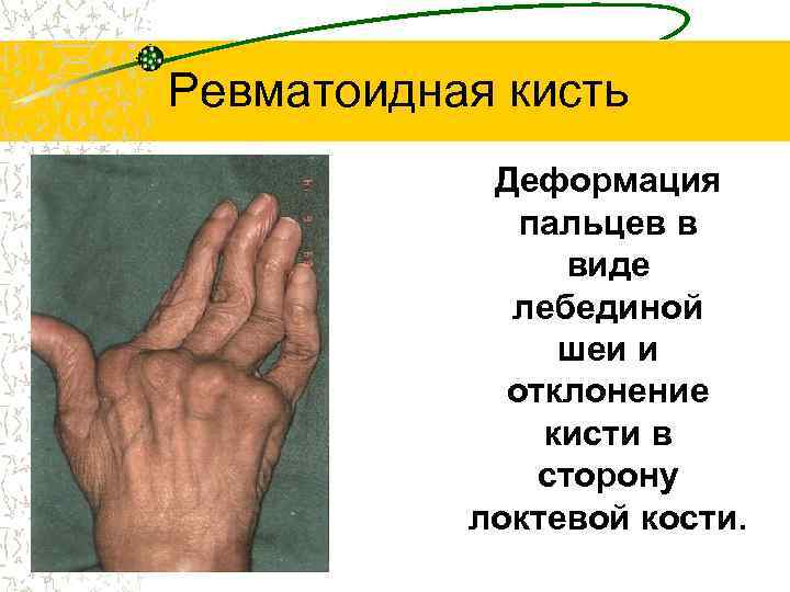 Ревматоидная кисть • Деформация пальцев в виде лебединой шеи и отклонение кисти в сторону