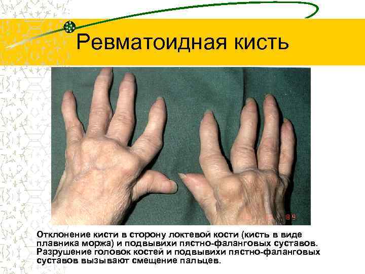 Ревматоидная кисть • Отклонение кисти в сторону локтевой кости (кисть в виде плавника моржа)