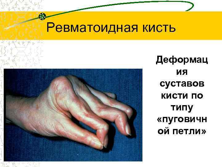 Ревматоидная кисть • Деформац ия суставов кисти по типу «пуговичн ой петли» 