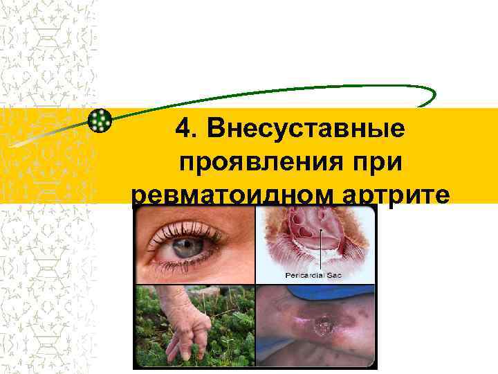 4. Внесуставные проявления при ревматоидном артрите 