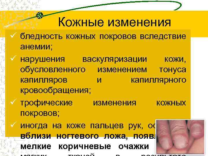 Кожные изменения ü бледность кожных покровов вследствие анемии; ü нарушения васкуляризации кожи, обусловленного изменением