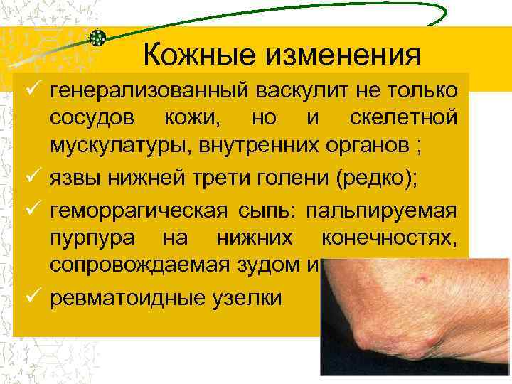 Кожные изменения ü генерализованный васкулит не только сосудов кожи, но и скелетной мускулатуры, внутренних