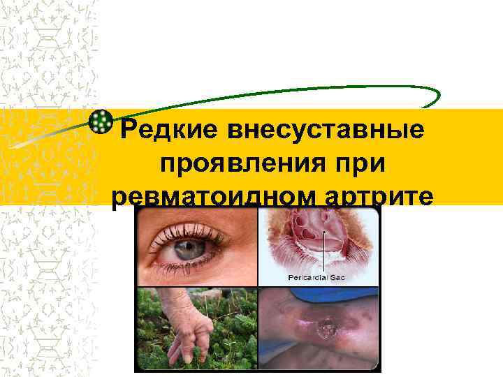 Редкие внесуставные проявления при ревматоидном артрите 