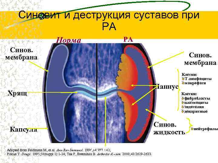 Синовит и деструкция суставов при РА Норма РА Inflamed Синов. мембрана Паннус Хрящ Клетки: