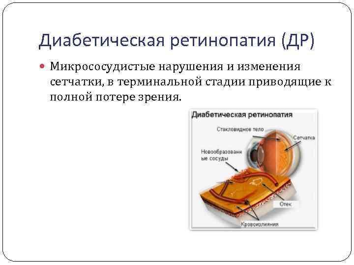 Диабетическая ретинопатия (ДР) Микрососудистые нарушения и изменения сетчатки, в терминальной стадии приводящие к полной