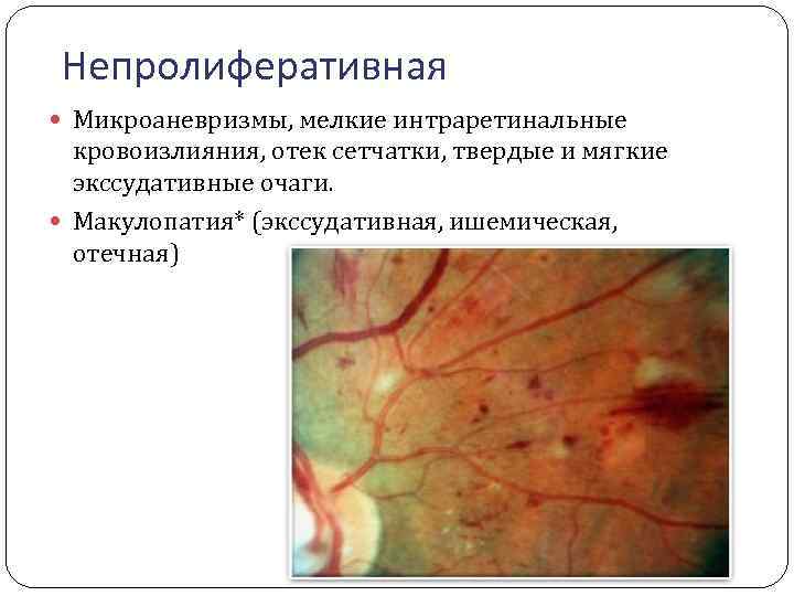 Непролиферативная Микроаневризмы, мелкие интраретинальные кровоизлияния, отек сетчатки, твердые и мягкие экссудативные очаги. Макулопатия* (экссудативная,