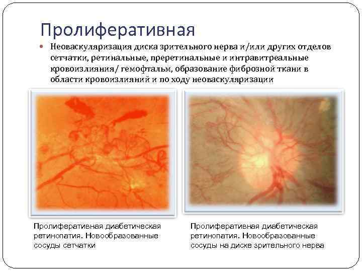 Пролиферативная Неоваскуляризация диска зрительного нерва и/или других отделов сетчатки, ретинальные, преретинальные и интравитреальные кровоизлияния/