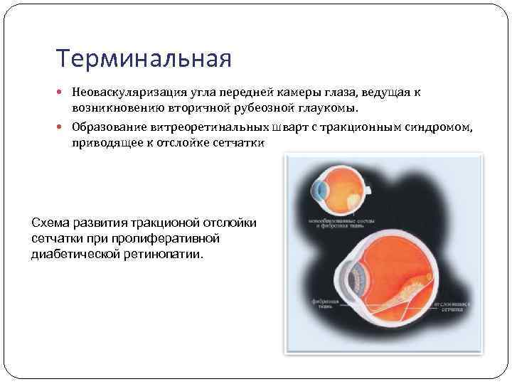 Терминальная Неоваскуляризация угла передней камеры глаза, ведущая к возникновению вторичной рубеозной глаукомы. Образование витреоретинальных