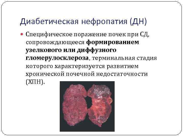 Диабетическая нефропатия (ДН) Специфическое поражение почек при СД, сопровождающееся формированием узелкового или диффузного гломерулосклероза,