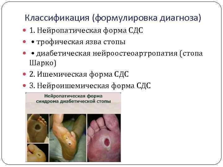 Классификация (формулировка диагноза) 1. Нейропатическая форма СДС • трофическая язва стопы • диабетическая нейроостеоартропатия
