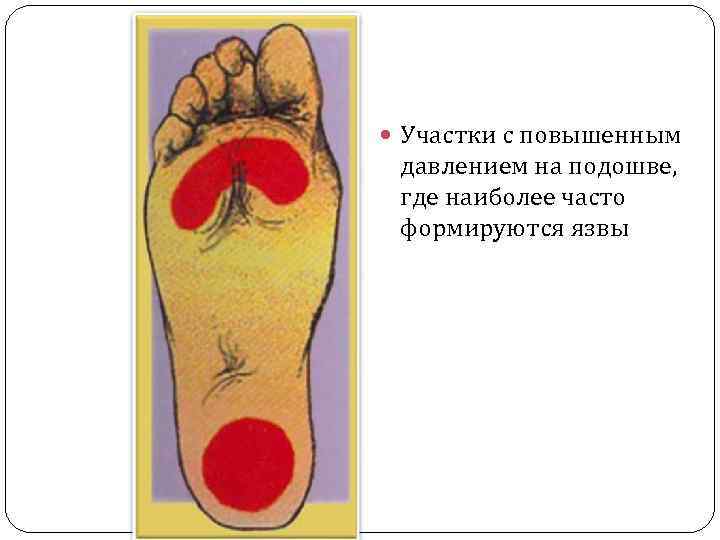  Участки с повышенным давлением на подошве, где наиболее часто формируются язвы 