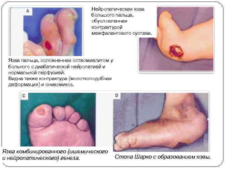 Нейропатическая язва большого пальца, обусловленная контрактурой межфалангового сустава. Язва пальца, осложненная остеомиелитом у больного
