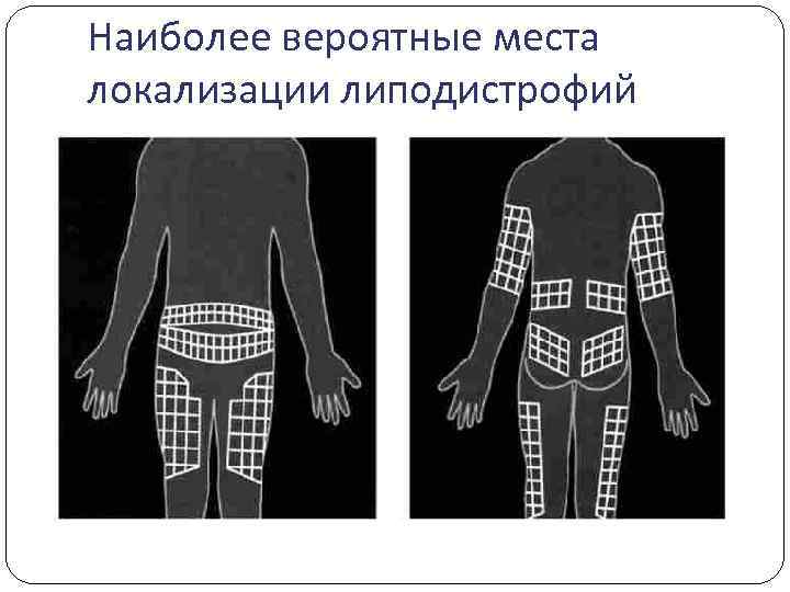 Наиболее вероятные места локализации липодистрофий 