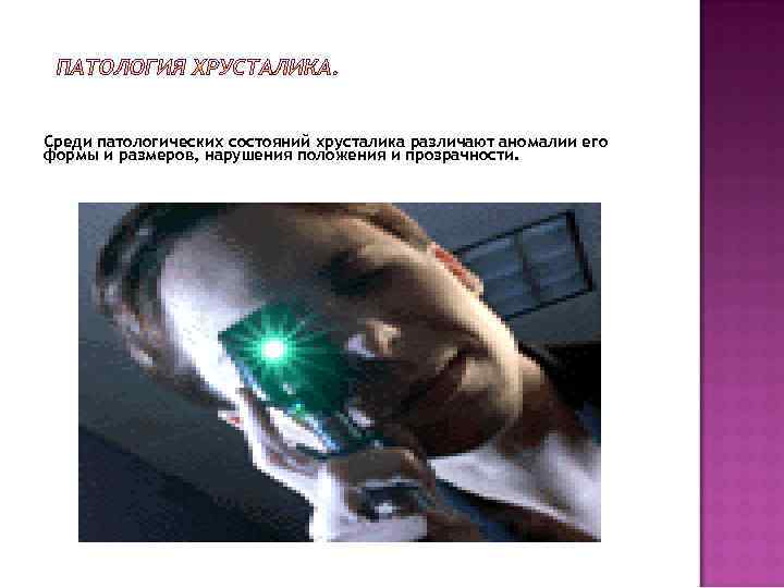 Среди патологических состояний хрусталика различают аномалии его формы и размеров, нарушения положения и прозрачности.