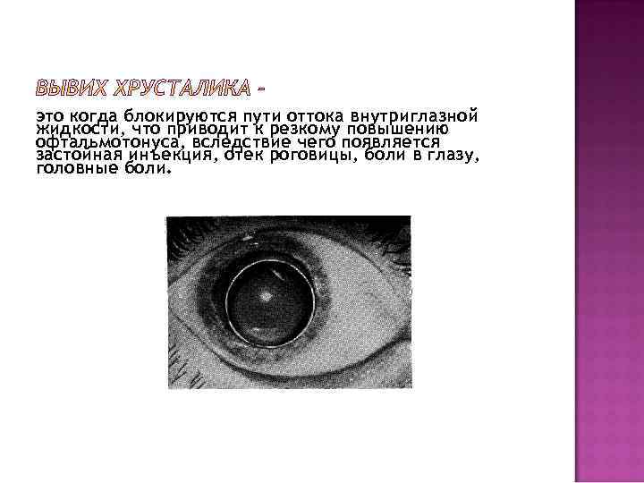 это когда блокируются пути оттока внутриглазной жидкости, что приводит к резкому повышению офтальмотонуса, вследствие