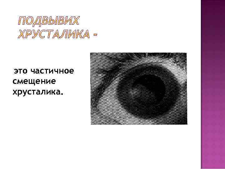 это частичное смещение хрусталика. 