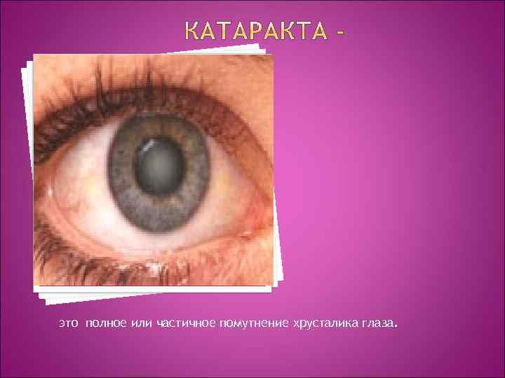 это полное или частичное помутнение хрусталика глаза. 