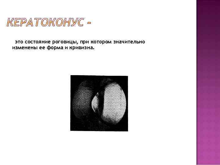 это состояние роговицы, при котором значительно изменены ее форма и кривизна. 