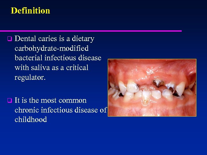 Definition q Dental caries is a dietary carbohydrate-modified bacterial infectious disease with saliva as