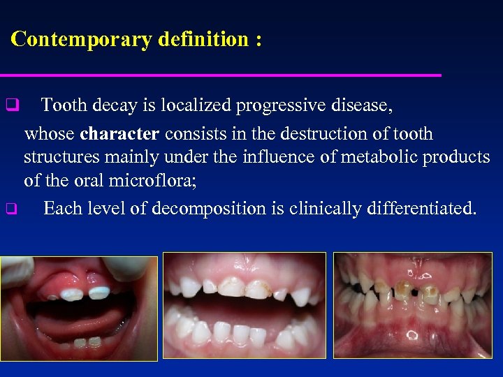  Contemporary definition : q Tooth decay is localized progressive disease, whose character consists