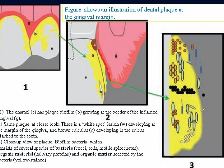 Figure shows an illustration of dental plaque at the gingival margin. 1) The enamel