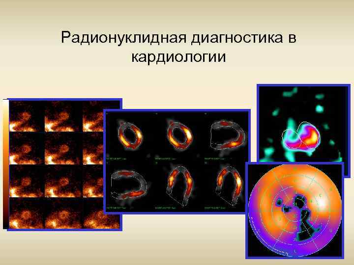 Радионуклидная диагностика в кардиологии 