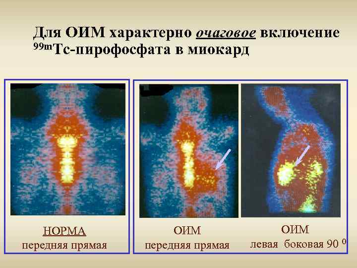 Для ОИМ характерно очаговое включение 99 m. Tc-пирофосфата в миокард НОРМА передняя прямая ОИМ
