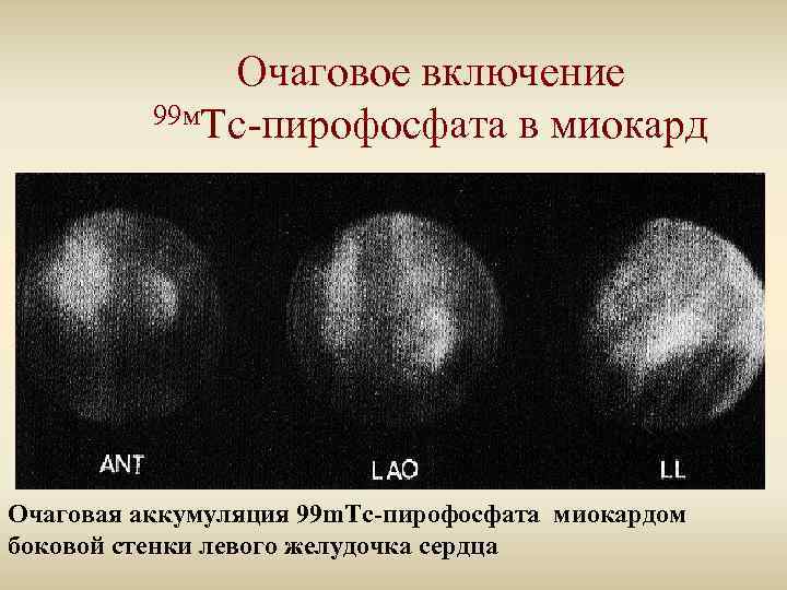 Очаговое включение 99 м. Тс-пирофосфата в миокард Очаговая аккумуляция 99 m. Тс-пирофосфата миокардом боковой