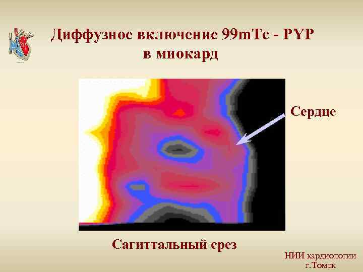 Диффузное включение 99 m. Тс - PYP в миокард Сердце Сагиттальный срез НИИ кардиологии