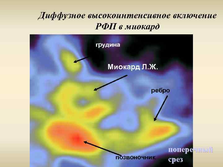 Диффузное высокоинтенсивное включение РФП в миокард грудина Миокард Л. Ж. ребро позвоночник поперечный срез