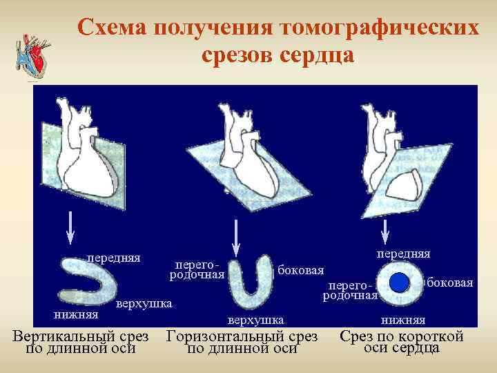 Схема получения томографических срезов сердца передняя нижняя перегородочная передняя боковая верхушка Вертикальный срез по