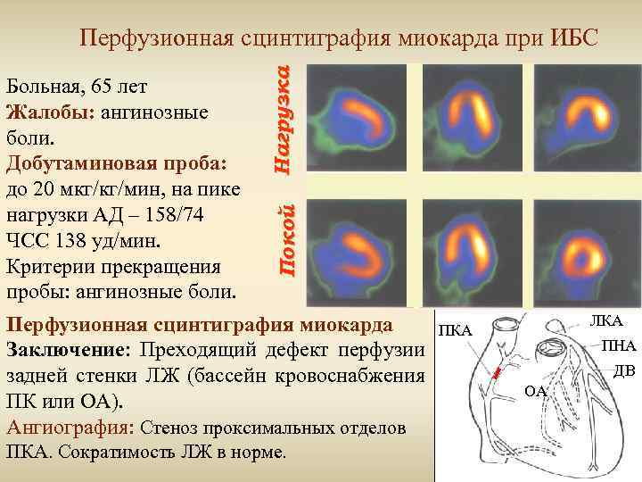 Покой Больная, 65 лет Жалобы: ангинозные боли. Добутаминовая проба: до 20 мкг/кг/мин, на пике