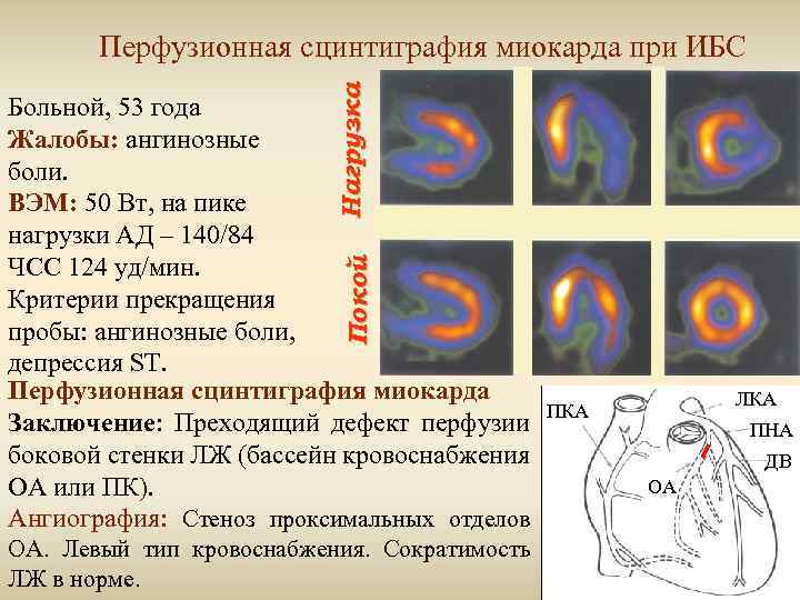 Нагрузка Перфузионная сцинтиграфия миокарда при ИБС Покой Больной, 53 года Жалобы: ангинозные боли. ВЭМ: