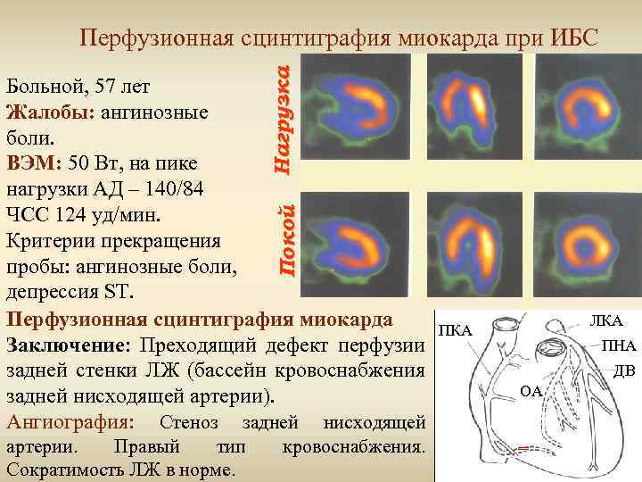 Нагрузка Перфузионная сцинтиграфия миокарда при ИБС Покой Больной, 57 лет Жалобы: ангинозные боли. ВЭМ: