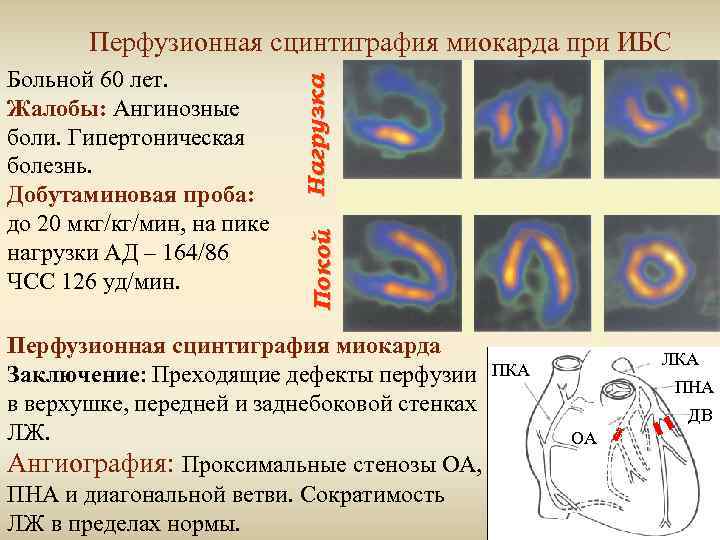 Покой Больной 60 лет. Жалобы: Ангинозные боли. Гипертоническая болезнь. Добутаминовая проба: до 20 мкг/кг/мин,