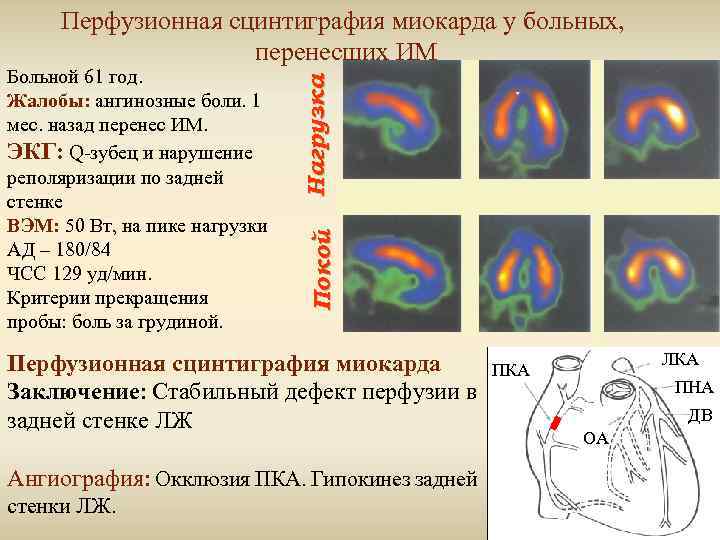 Покой Больной 61 год. Жалобы: ангинозные боли. 1 мес. назад перенес ИМ. ЭКГ: Q-зубец