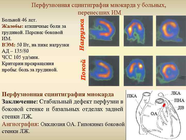 Покой Больной 46 лет. Жалобы: атипичные боли за грудиной. Перенес боковой ИМ. ВЭМ: 50