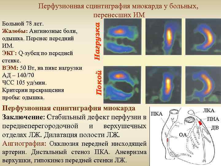 Покой Больной 78 лет. Жалобы: Ангинозные боли, одышка. Перенес передний ИМ. ЭКГ: Q-зубец по