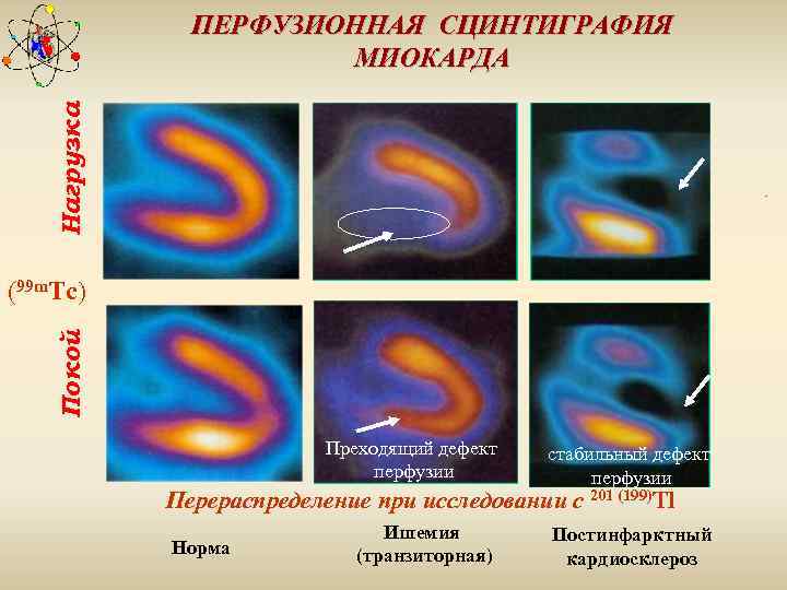 Нагрузка ПЕРФУЗИОННАЯ СЦИНТИГРАФИЯ МИОКАРДА Покой (99 m. Tc) Преходящий дефект перфузии стабильный дефект перфузии