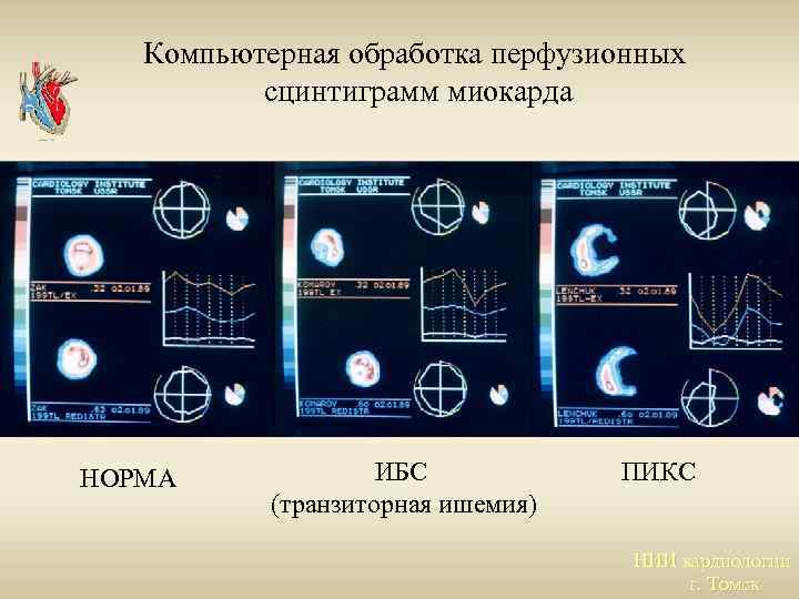 Компьютерная обработка перфузионных сцинтиграмм миокарда НОРМА ИБС (транзиторная ишемия) ПИКС НИИ кардиологии г. Томск