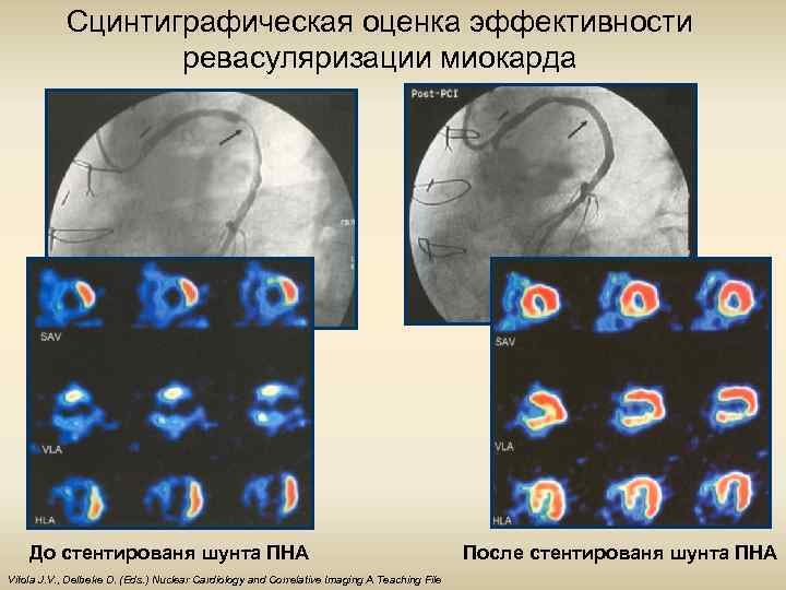 Сцинтиграфическая оценка эффективности ревасуляризации миокарда До стентированя шунта ПНА Vitola J. V. , Delbeke