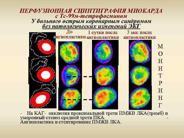 Сцинтиграфия миокарда. Сцинтиграфия перфузионная миокарда (нагрузочная). Радионуклидная сцинтиграфия миокарда. Сцинтиграфия с тс99. Перфузионная сцинтиграфия миокарда сердца.