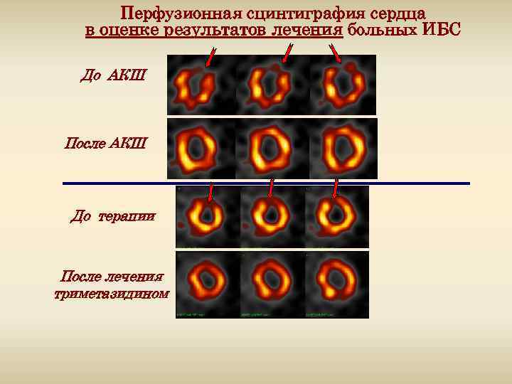 Перфузионная сцинтиграфия сердца в оценке результатов лечения больных ИБС До АКШ После АКШ До