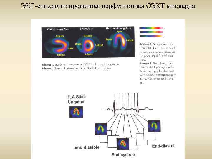 ЭКГ-синхронизированная перфузионная ОЭКТ миокарда 