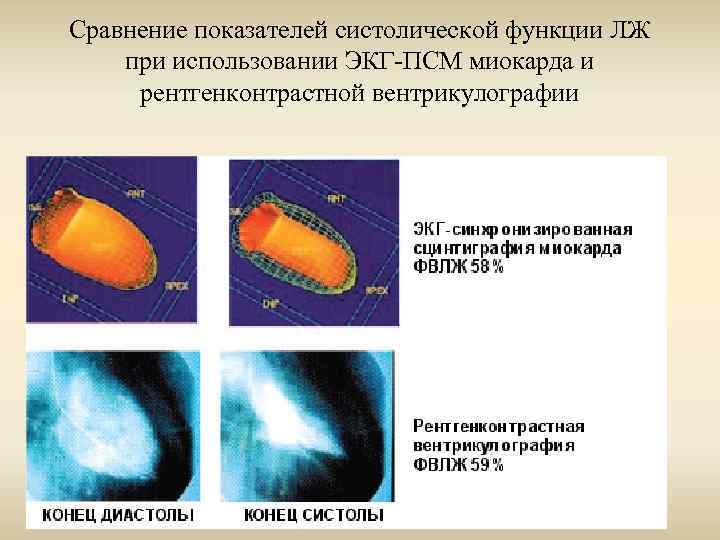 Сравнение показателей систолической функции ЛЖ при использовании ЭКГ-ПСМ миокарда и рентгенконтрастной вентрикулографии 